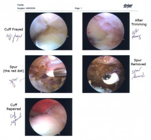 Rotator Cuff Repair Rotator Cuff Repair